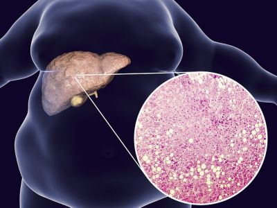 Λίπος στο συκώτι: Με ποιες τροφές θα το μειώσετε (εικόνες)