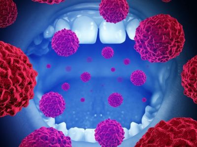 Στοματικός καρκίνος: Συμπτώματα, παράγοντες κινδύνου & τρόποι αντιμετώπισης (βίντεο)