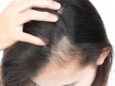 Αραίωση μαλλιών: Ποιες είναι οι πιθανές αιτίες (εικόνες)