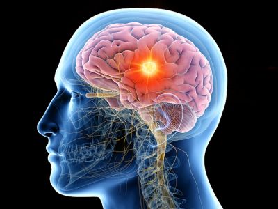 Όγκος στον εγκέφαλο: 7 προειδοποιητικά σημάδια που πρέπει να ξέρετε (βίντεο)