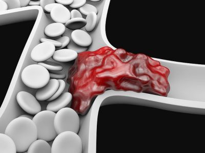 Θρόμβωση: Οι σημαντικοί παράγοντες κινδύνου (εικόνες)