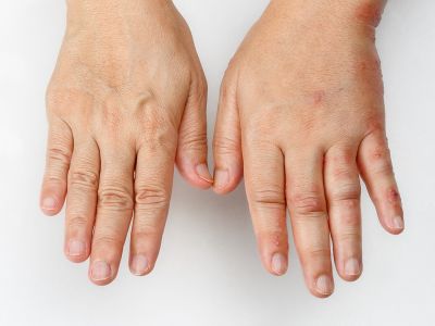 Πρήξιμο: Πότε είναι ανησυχητικό (βίντεο)