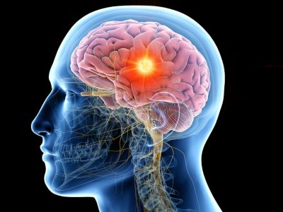 Όγκος στον εγκέφαλο: 6 σημεία-κλειδιά που πρέπει να γνωρίζετε (εικόνες)