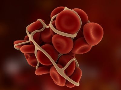 Θρόμβος στο πόδι: 5 τροφές που τον προλαμβάνουν (εικόνες)