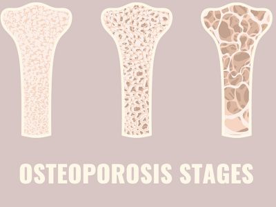 Μέτρηση οστικής πυκνότητας: Ποιοι και πότε πρέπει να κάνουν την εξέταση (εικόνες)