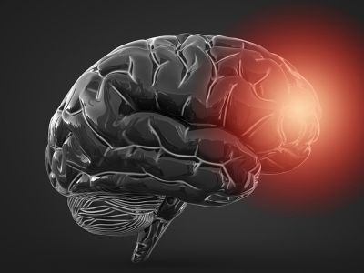 Εγκεφαλικό: Ποιοι ανήκουν στις ομάδες υψηλού κινδύνου (εικόνες)