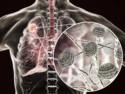 Απόστημα πνεύμονα: Με ποια συμπτώματα εκδηλώνεται (εικόνες)