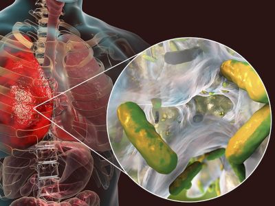 Ψευδομονάδα: Τα συμπτώματα της λοίμωξης από το ανθεκτικό μικρόβιο (εικόνες)