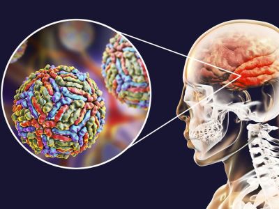 Εγκεφαλίτιδα: 6 ενδείξεις σε εικόνες