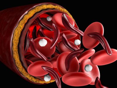 10 ενδείξεις ότι έχετε έλλειψη σιδήρου (εικόνες)