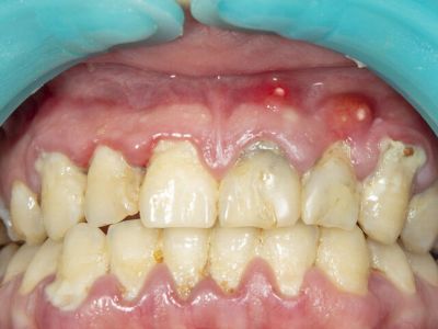 Απόστημα στο δόντι: 4 φυσικοί τρόποι αντιμετώπισης (εικόνες)