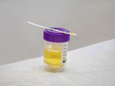 Ούρα: Ποια προβλήματα υγείας επηρεάζουν το χρώμα τους (εικόνες)