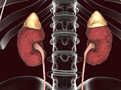 Οξεία πυελονεφρίτιδα: 7 συμπτώματα που δεν πρέπει να αγνοήσετε (εικόνες)