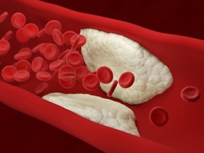 Φραγμένες αρτηρίες: Αυτές είναι οι 12 απαγορευμένες τροφές (εικόνες)