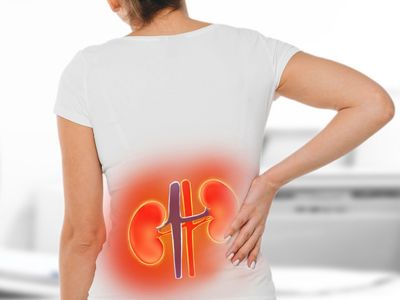 Πέτρες στα νεφρά: 7 σημεία-κλειδιά που πρέπει να γνωρίζετε (εικόνες)