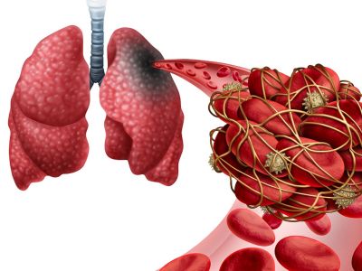 Πνευμονική εμβολή: Πότε πρέπει να αναζητήσετε επειγόντως ιατρική βοήθεια (εικόνες)