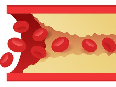 Στεφανιαία νόσος: Τα προειδοποιητικά συμπτώματα που πρέπει να γνωρίζετε (εικόνες)