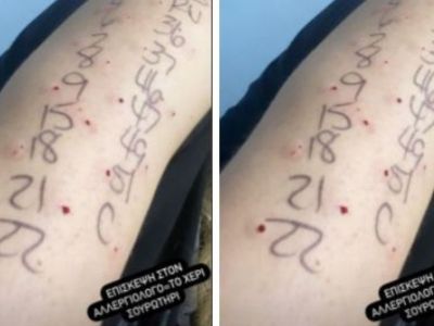 Ελληνίδα μαμά μας δείχνει το χέρι της μετά την επίσκεψη σε αλλεργιολόγο