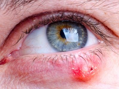 Κριθαράκι στο μάτι: 4 φυσικοί τρόποι αντιμετώπισης (εικόνες)