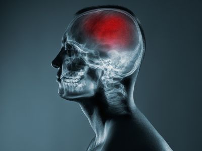 Αγγειακό εγκεφαλικό: Οι παράγοντες που πρέπει να ελέγχετε (εικόνες)