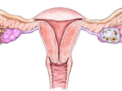 Καρκίνος ενδομητρίου: Τα γενικά συμπτώματα που πρέπει να γνωρίζετε (εικόνες)