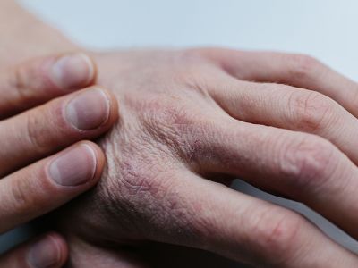 Ξηροδερμία: Με ποια προβλήματα υγείας συνδέεται (εικόνες)