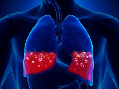 Ποιοι 40άρηδες κινδυνεύουν από πνευμονική εμβολή