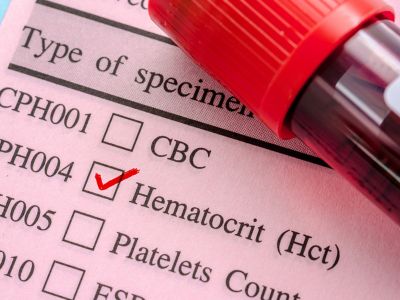 Χαμηλός αιματοκρίτης: Οι πιθανές αιτίες σε εικόνες
