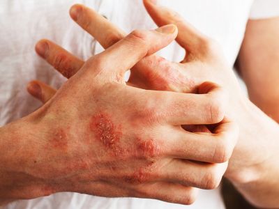 Αυτοάνοσα: Οι βασικές ενδείξεις που πρέπει να γνωρίζετε (εικόνες)