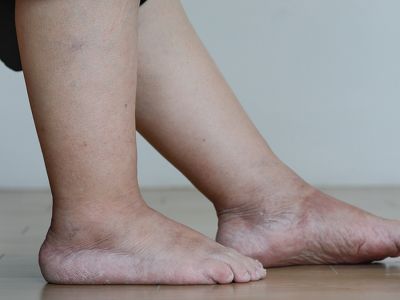 Πρησμένα πόδια: Τι να κάνετε για να υποχωρήσει το οίδημα (εικόνες)