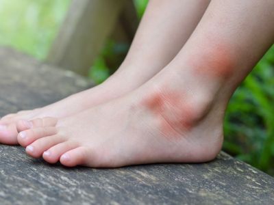 Αλλεργία στο τσίμπημα κουνουπιού: Τα ανησυχητικά συμπτώματα (εικόνες)