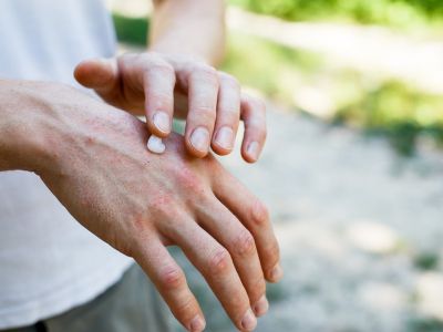 Ξηρή επιδερμίδα το καλοκαίρι: Πώς θα την αντιμετωπίσετε (εικόνες)