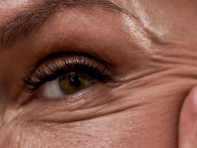 Ρυτίδες: Τι δείχνουν για την υγεία σας (εικόνες)