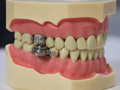 «Κλειδαριά» στα σαγόνια για επιτυχές αδυνάτισμα