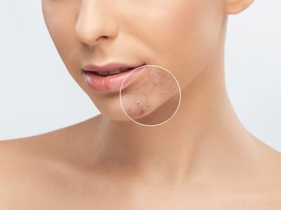 Ακμή και καλοκαίρι: Τι πρέπει να γνωρίζετε (εικόνες)