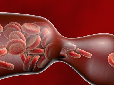 Θρόμβωση: Για ποιες αιτίες καρδιαγγειακού θανάτου ευθύνεται (εικόνες)