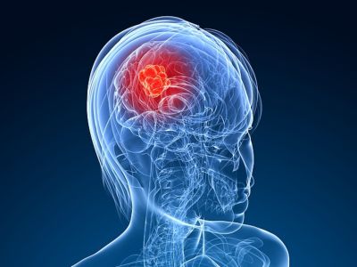 Καρκίνος στο κεφάλι: Κοινά συμπτώματα που δεν πρέπει να αγνοείτε (εικόνες)