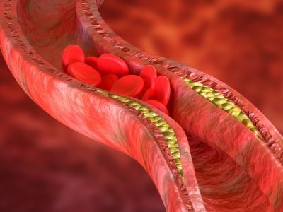 Περιφερική αρτηριοπάθεια: Τα συμπτώματα που πρέπει να γνωρίζετε (εικόνες)