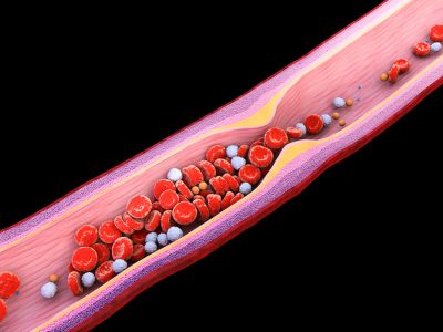 Υψηλή χοληστερίνη: Οι άγνωστες επιπτώσεις πλην του εμφράγματος και του εγκεφαλικού (εικόνες)