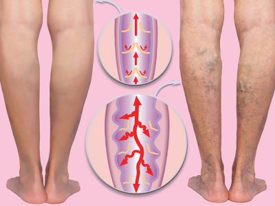 Οι τροφές που προστατεύουν τις φλέβες και τις αρτηρίες (εικόνες)