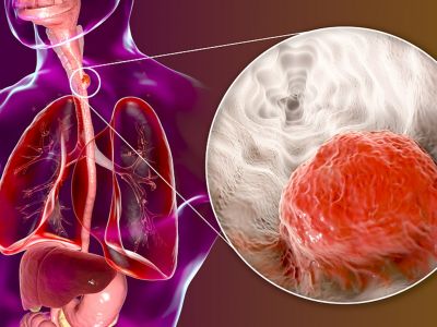 Καρκίνος οισοφάγου: Πώς θα μειώσετε τον κίνδυνο (εικόνες)