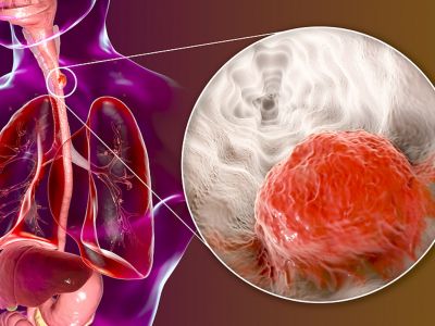 Καρκίνος οισοφάγου: Με ποια συμπτώματα εκδηλώνεται (εικόνες)