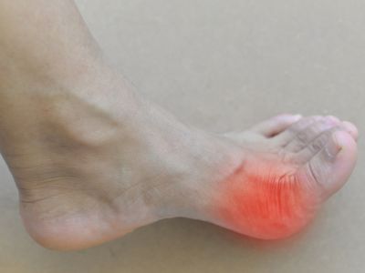 Υψηλό ουρικό οξύ: Πώς θα προλάβετε τα επεισόδια ουρικής αρθρίτιδας φυσικά (εικόνες)