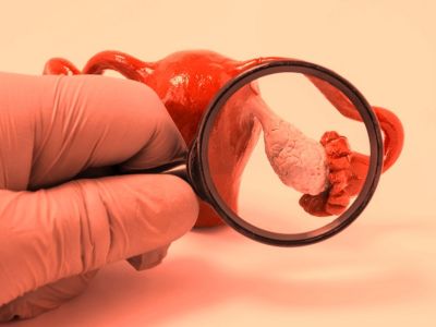 Καρκίνος ωοθηκών: 8 πρώιμα συμπτώματα του θανατηφόρου γυναικολογικού καρκίνου (εικόνες)