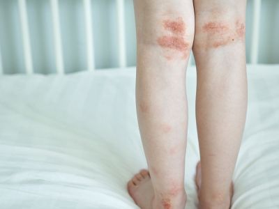 Παγκόσμια Ημέρα Ατοπικής Δερματίτιδας: Η βιταμίνη που ανακουφίζει από τα συμπτώματα (εικόνες)