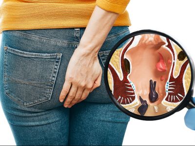 Αιμορροΐδοπάθεια: Ποιοι κινδυνεύουν περισσότερο (εικόνες)