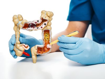 Καρκίνος παχέος εντέρου: Τι μπορείτε να κάνετε για να τον προλάβετε (εικόνες)