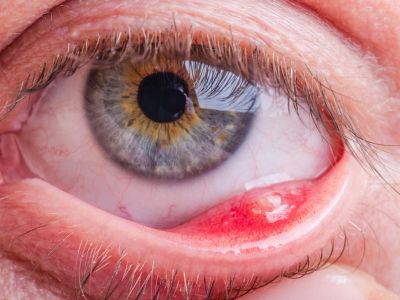 Κριθαράκι στο μάτι: 9 εύκολοι τρόποι για να υποχωρήσει (εικόνες)