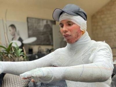 Ο σχεδιαστής του οίκου Balmain σόκαρε τον πλανήτη – Η φωτό που αποκάλυψε το φρικτό ατύχημα