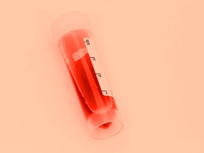 Αίμα στα ούρα: Όλες οι πιθανές αιτίες σε εικόνες